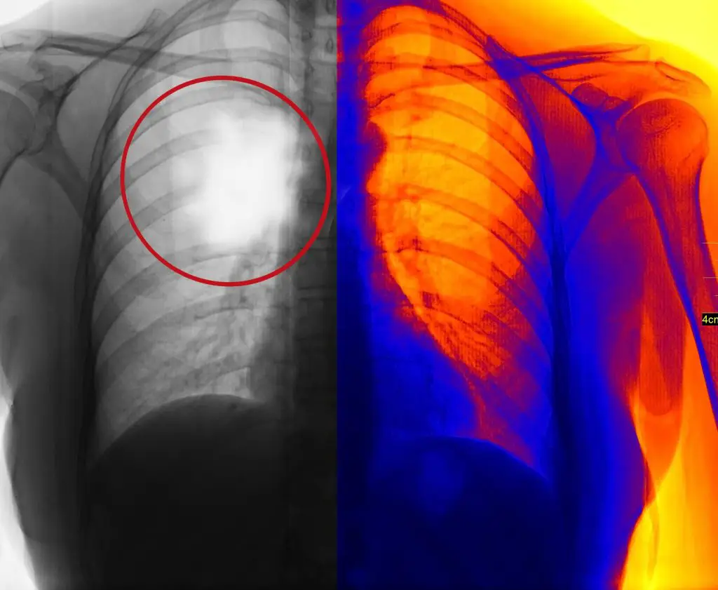 Mesothelioma Cancer